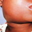 Factsheet: Key facts about Mumps – following Zimbabwe Disease Surveillance Report