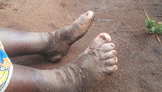 Factsheet: Facts about Elephantiasis