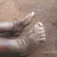 Factsheet: Facts about Elephantiasis